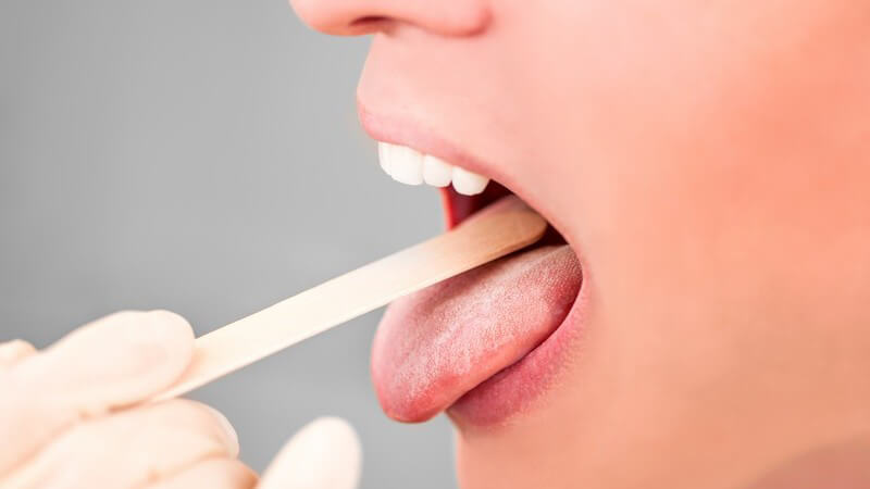 Mund- und Rachenraumuntersuchung mit Holzstäbchen bei einer jungen Frau