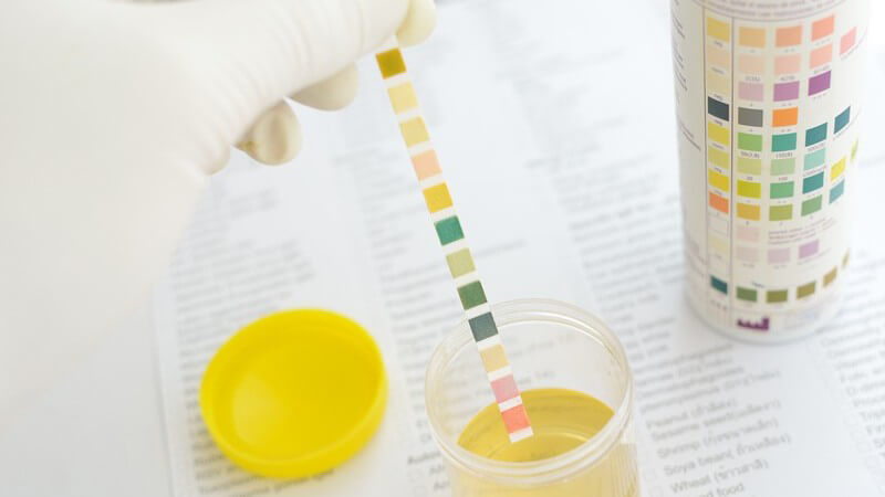 Untersuchung einer Urinprobe im Labor