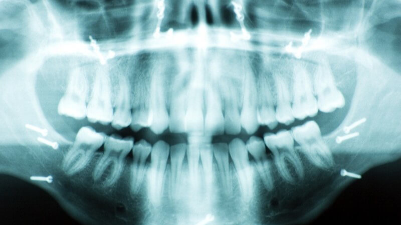 Röntgenbild Gebiss, Kiefer