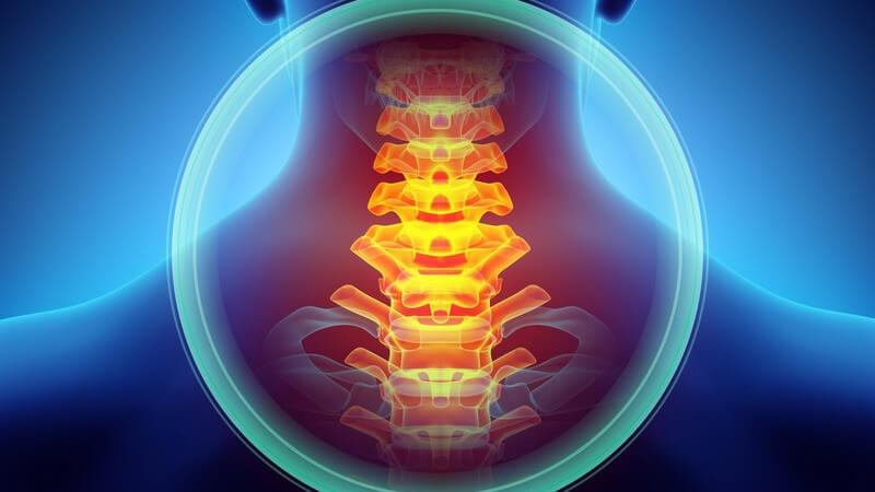 Blaue 3-D-Grafik des Rückens/Nackens mit Schmerzen im Nacken, Wirbel rot hervorgehoben und eingekreist