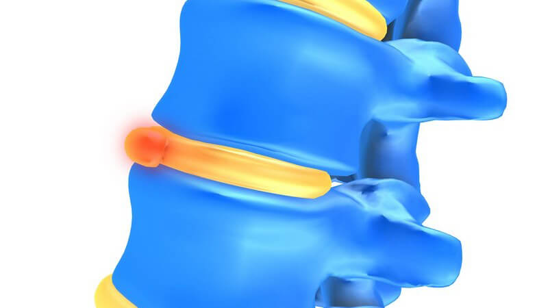 Anatomie - Grafik einer Wirbelsäule mit Bandscheibenvorfall