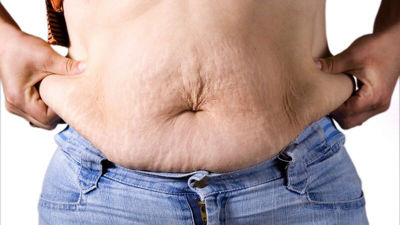 Nahaufnahme weiblicher Bauch mit Cellulite, Fettgewebe