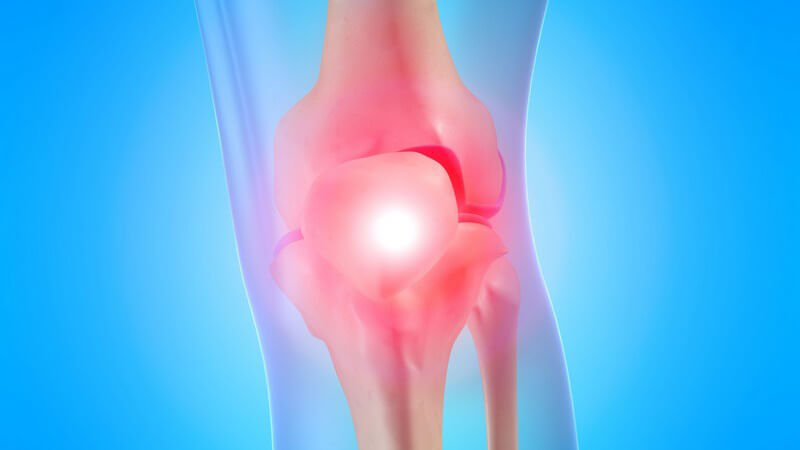 Grafik Kniegelenk mit Schmerzen