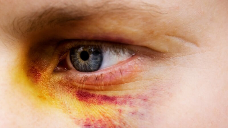 Linkes Auge einer Frau, darunter Blutergüsse