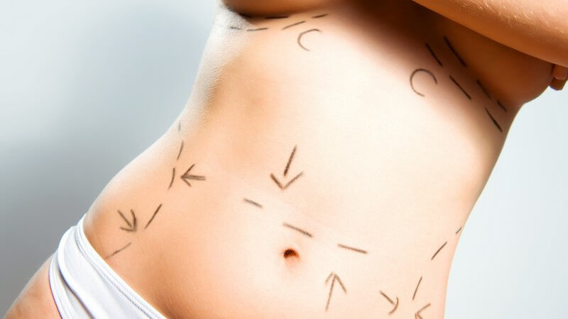 Frauenbauch und Brust vor Schönheitsoperation mit Stift gekennzeichnet