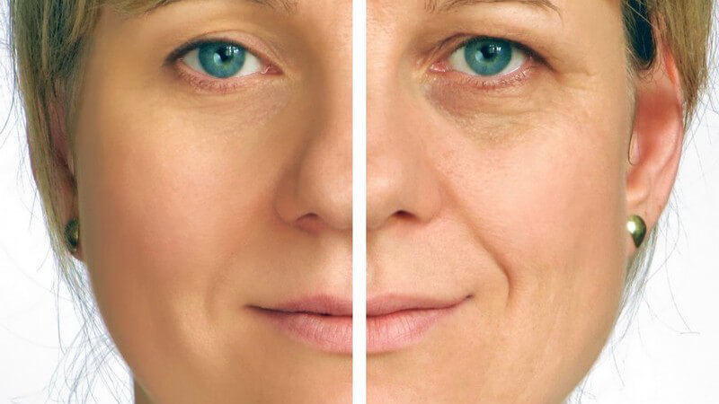 Zwei Gesichtshälften einer Frau - vor und nach der Faltenbehandlung