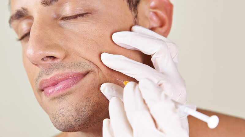 Mann bekommt eine Spritze zur Faltenbehandlung am Mundwinkel