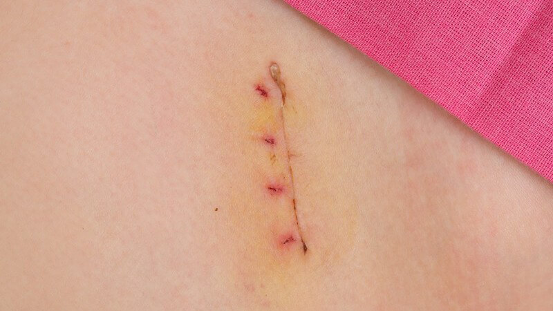 Frische Narbe einer genähten Operationswunde nach Blinddarmentfernung