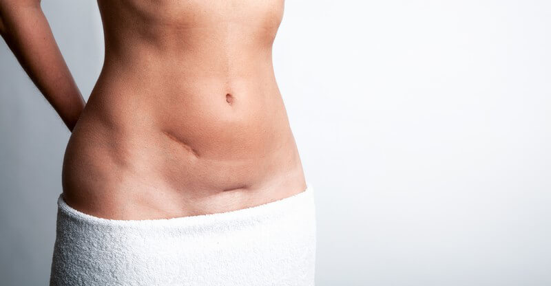 Unterleib einer Frau mit großen Narben durch Operationen