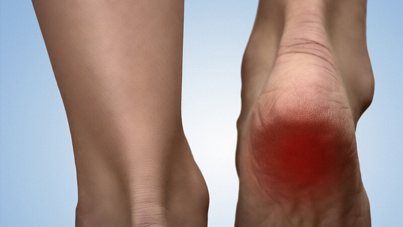 Nahaufnahme zweier Füße von hinten, der rechte Fuß ist angehoben und hat eine rote schmerzhafte Stelle