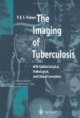 The Imaging of Tuberculosis. With Epidemiological, Pathological and Clinical Correlation