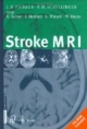Stroke MRI